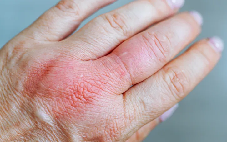 Geschwollene Finger mit einer Rötung im Handrückenbreich