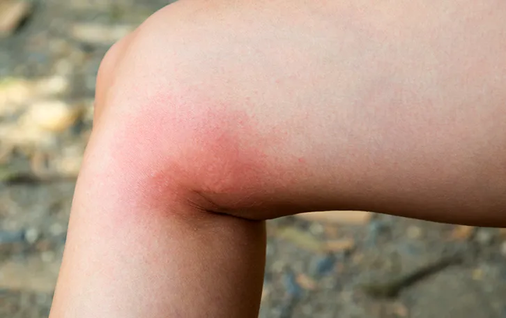 Starke Rötung im äußeren Kniegelenkbereich