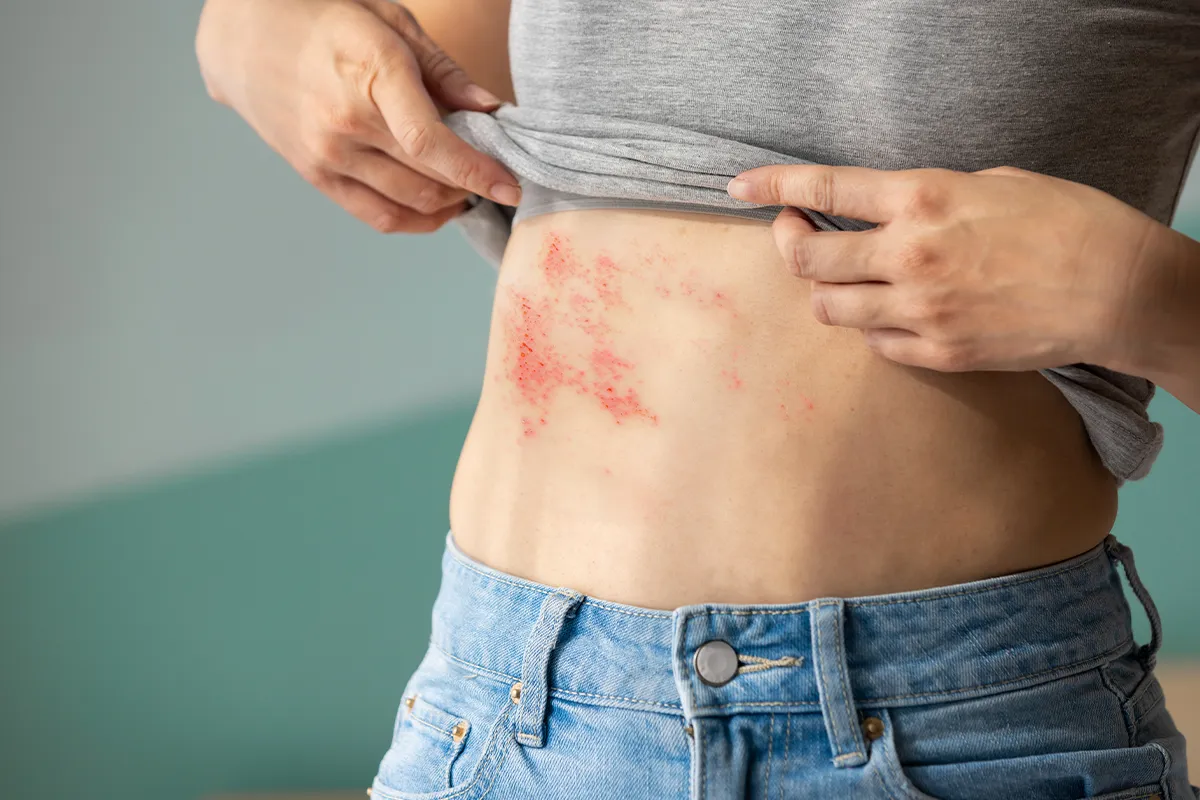 Großflächiges Ekzem im äußeren Bauchbereich mit blutigen offenen Rissen