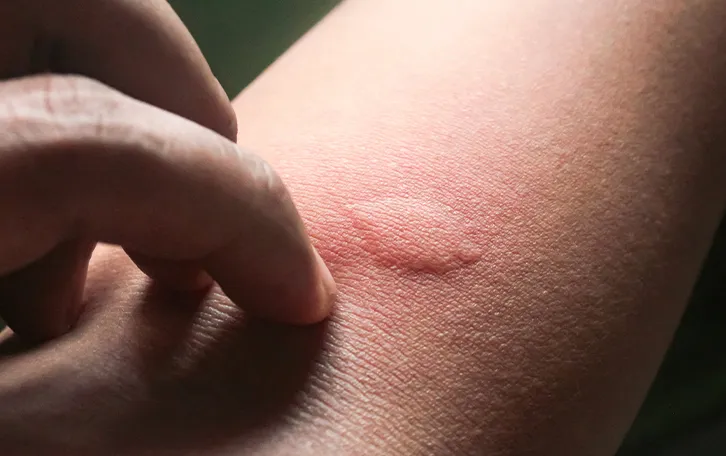 Ein dicke Quaddel mit starker Rötung drum herum. Finger sind zum kratzen angesetzt