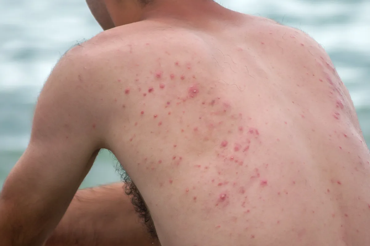 Mallorca Akne Gesunde Haut im Sommer Rötliche Pusteln im Schulterblattbereich einer männlichen Person