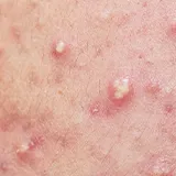 Mallorca Akne Symptome juckende Knötchen Nahaufnahme von eitrigen Pickelchen und weiteren rötlichen Stellen