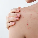 Mallorca Akne Symptome starkes Jucken Eine weibliche Person mit vielen rötlichen, teils offenen, Pickeln im Schulterbreich und im Gesicht