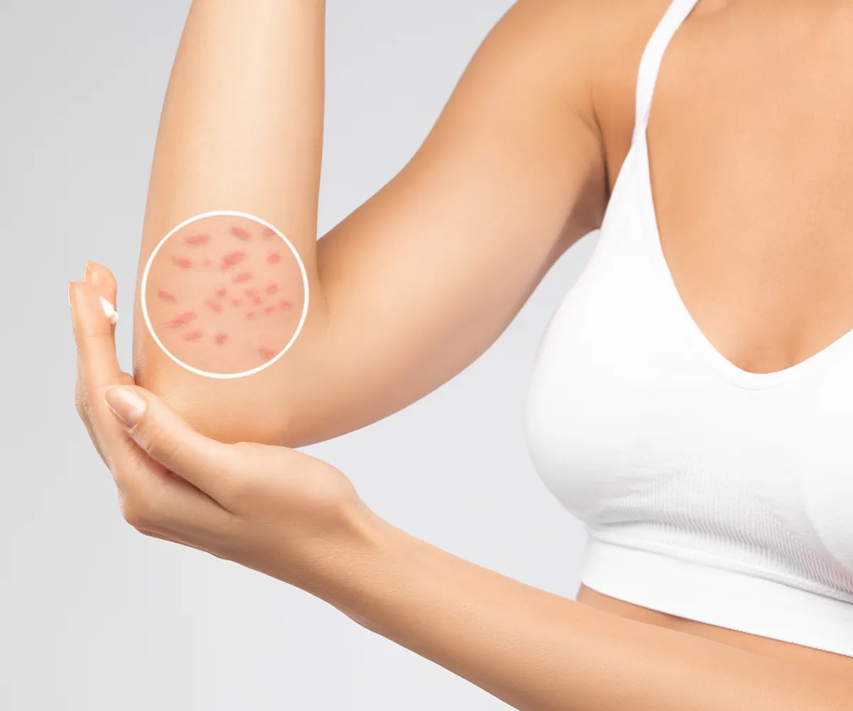 Die Armbeuge einer weblichen Person mit einer schemenhaftenVergrößerung der Beuge mit roten Hautstellen