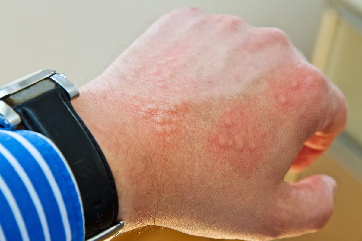 Ein Handrücken mit kleinen Pusteln