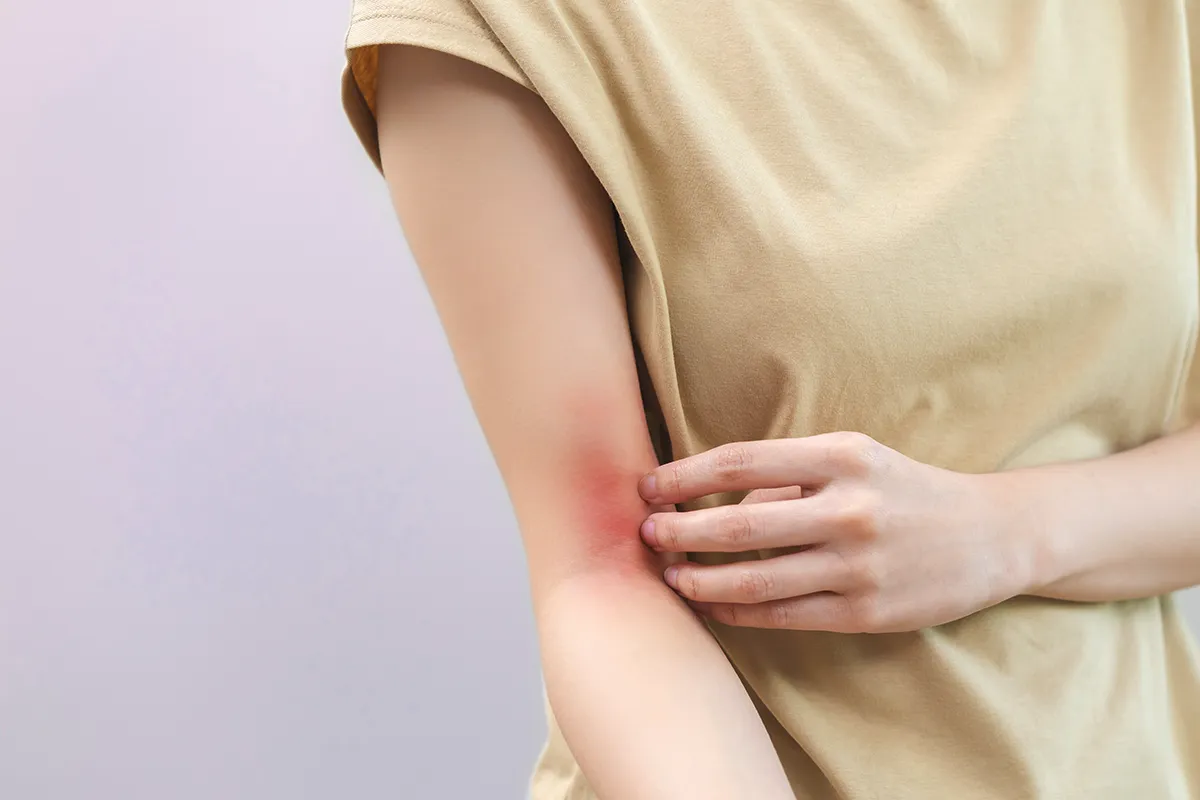 Soforthilfe gegen Juckreiz Rötung Eine weibliche Person mit einer rechten stark geröteten Ellebogenbeuge