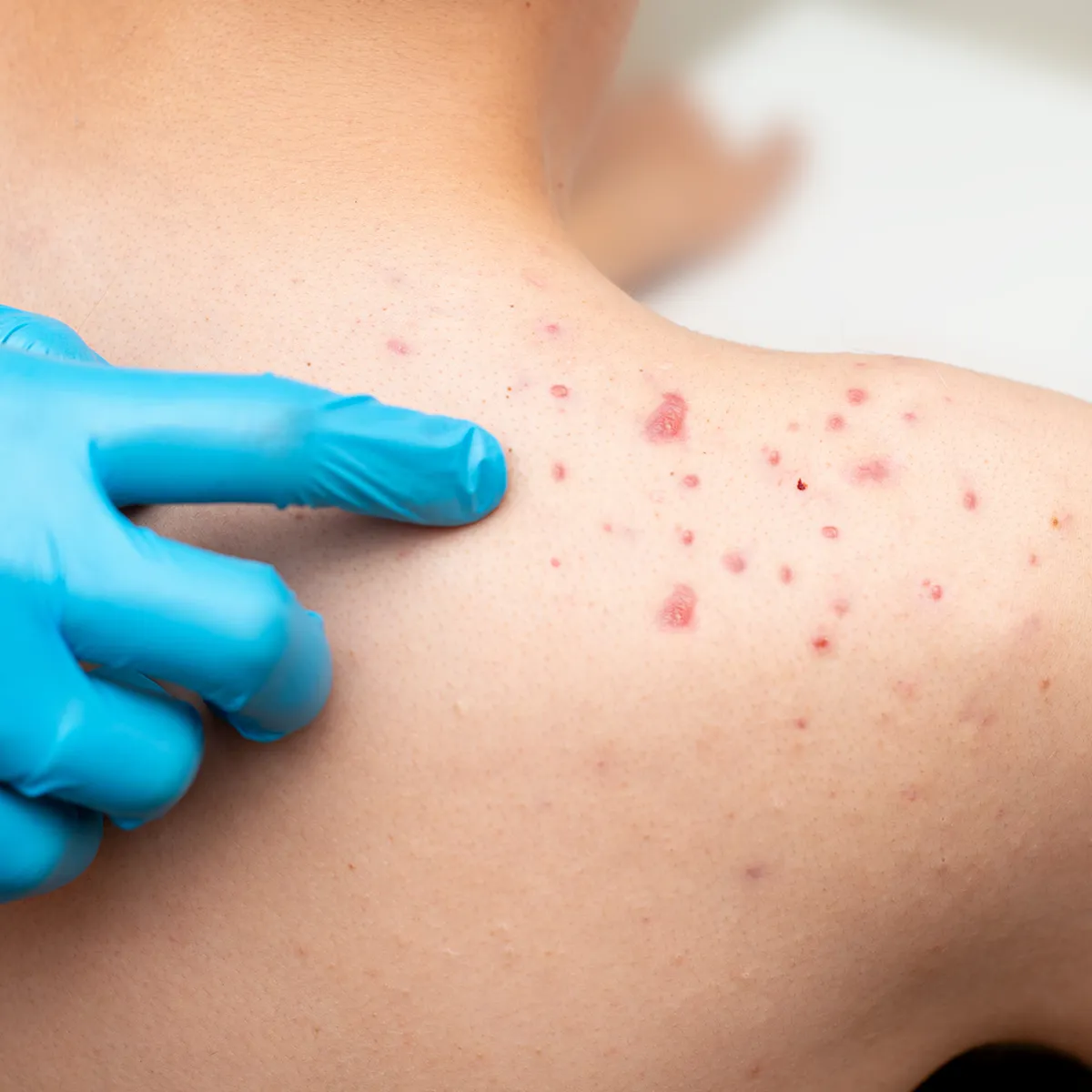 Finger in Latexhandschuhen zeigen auf rötliche Pusteln auf der Schulter einer Person