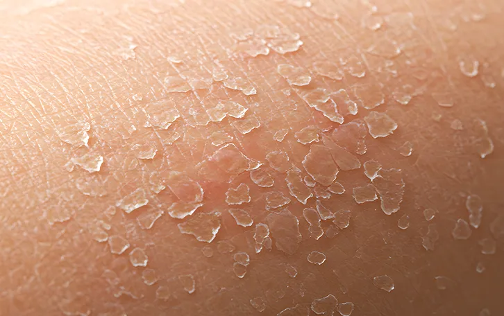 Abschuppungen auf der Haut