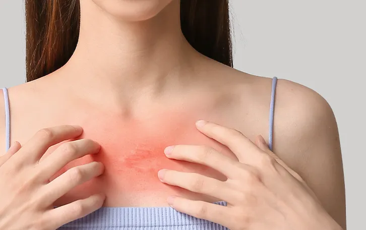 Starker dunkel roter Sonnenbrand mit Schwellungen und Blasen im Dekolletébereich