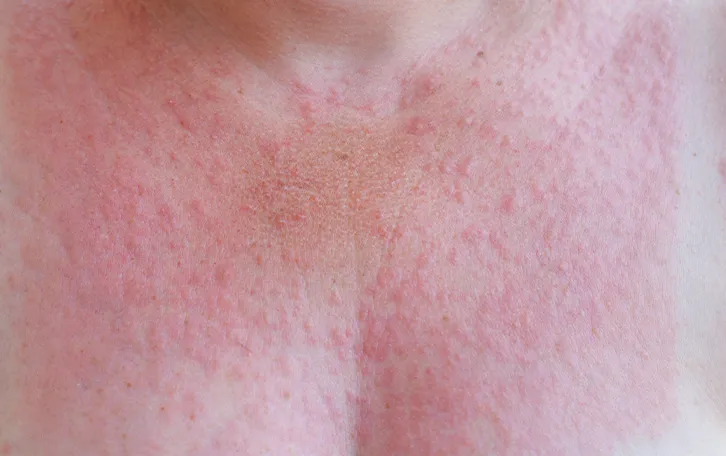 Viele rote kleine Pusteln im Dekolletébereich