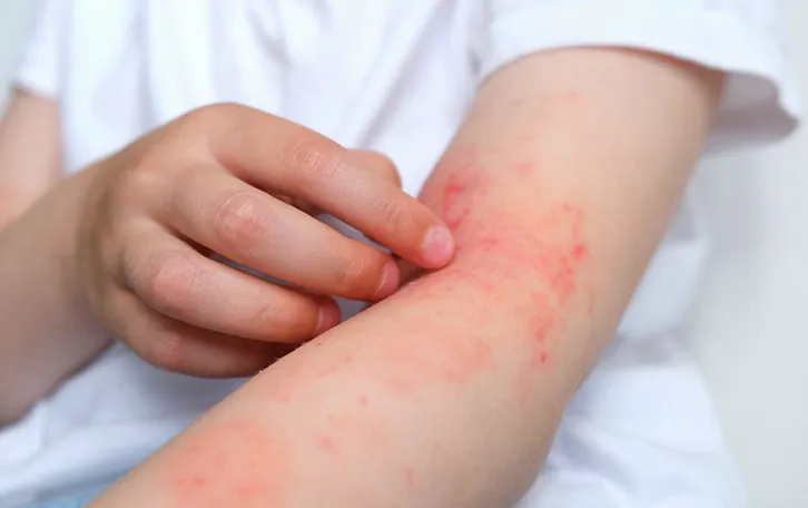 Eine Person kratzt sich an offenen Stellen am Unteraram und Beuge