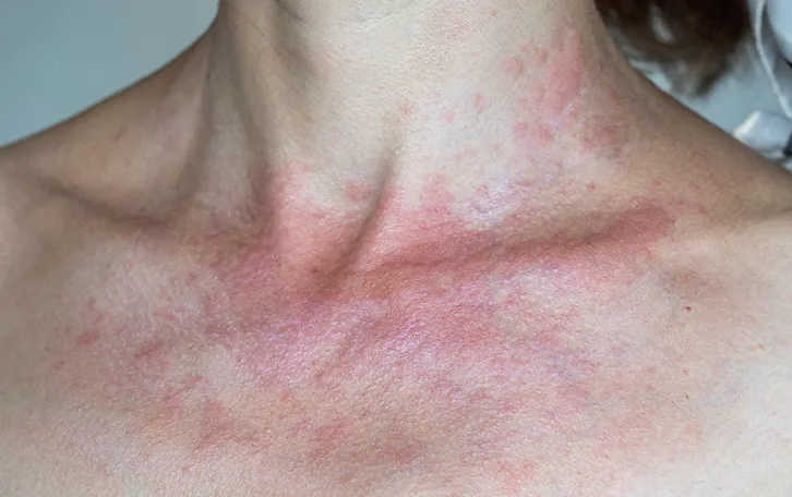 Rote Flecken im Dekolletébereich mit Quaddelbildung am Hals
