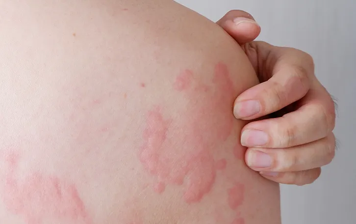 Rötliche geschwollene Hautbereiche im Schulter-/Oberarmbereich mit Quaddeln