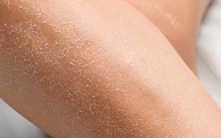 Großflächige trockene Hautpartien