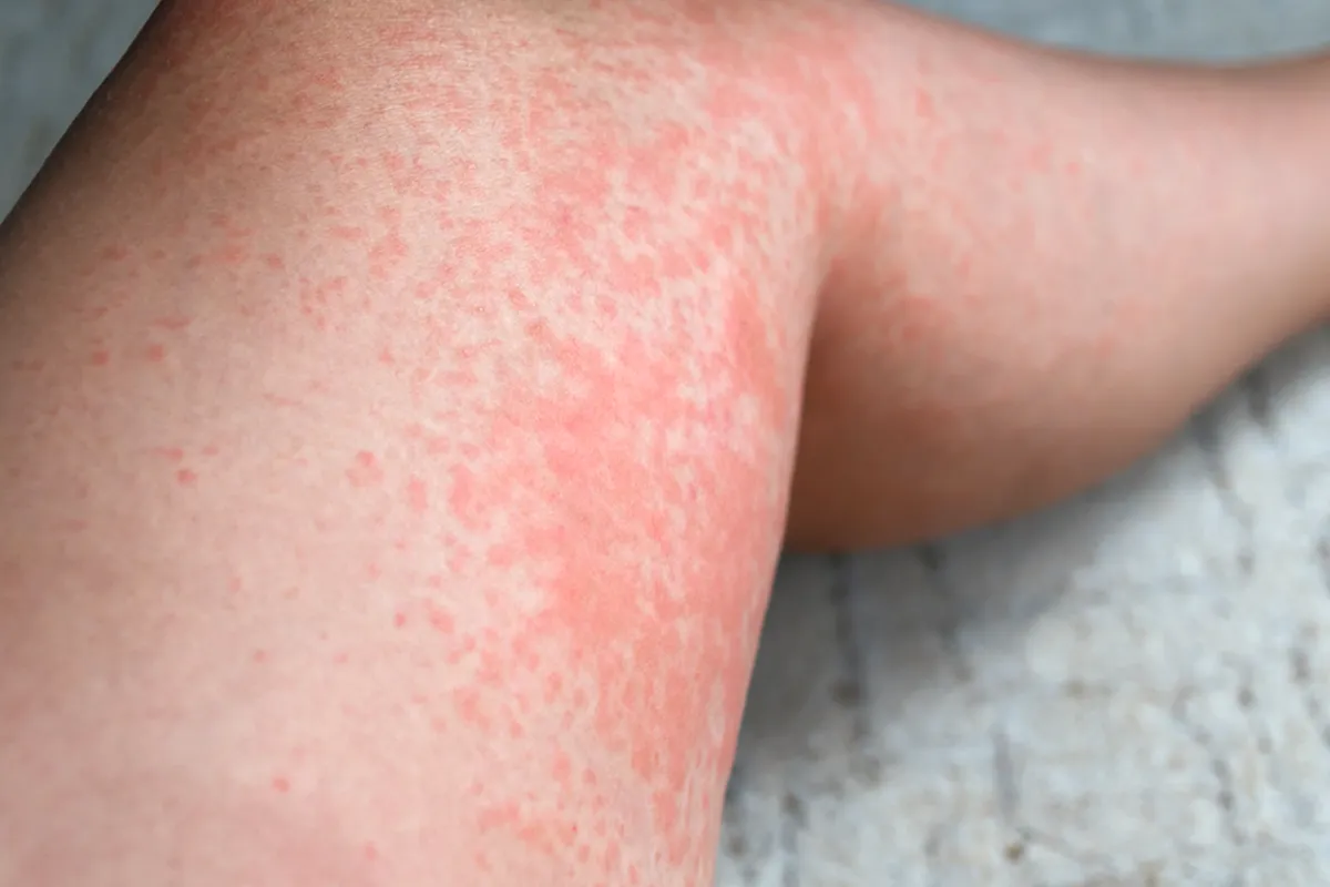 Großflächige rötliche Stelle im Kniebereich einer Person