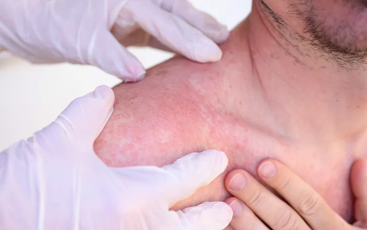 Sonnenbrand Anzeichen gereizte Haut Zwei Hände halten den geröteten Schulterbereich einer männlichen Person