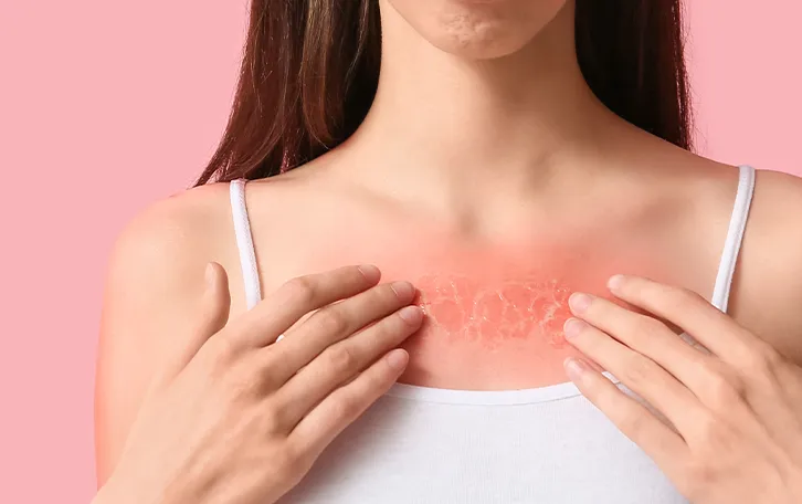 Sonnenbrand anzeichen Schwellungen Starker dunkel roter Sonnenbrand mit Schwellungen und Blasen im Dekolletébereich