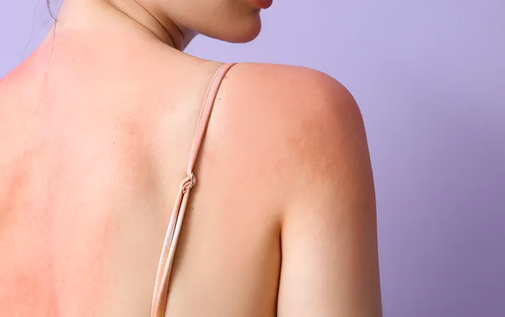 Sonnenbrand Soforthilfe Schmerzen lindern Der Rücken einer weiblichen Person, dieser ist großflächig mit Sonnenbrand bedeckt