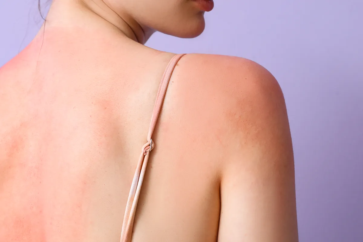 Der Rücken einer weiblichen Person, dieser ist großflächig mit Sonnenbrand bedeckt