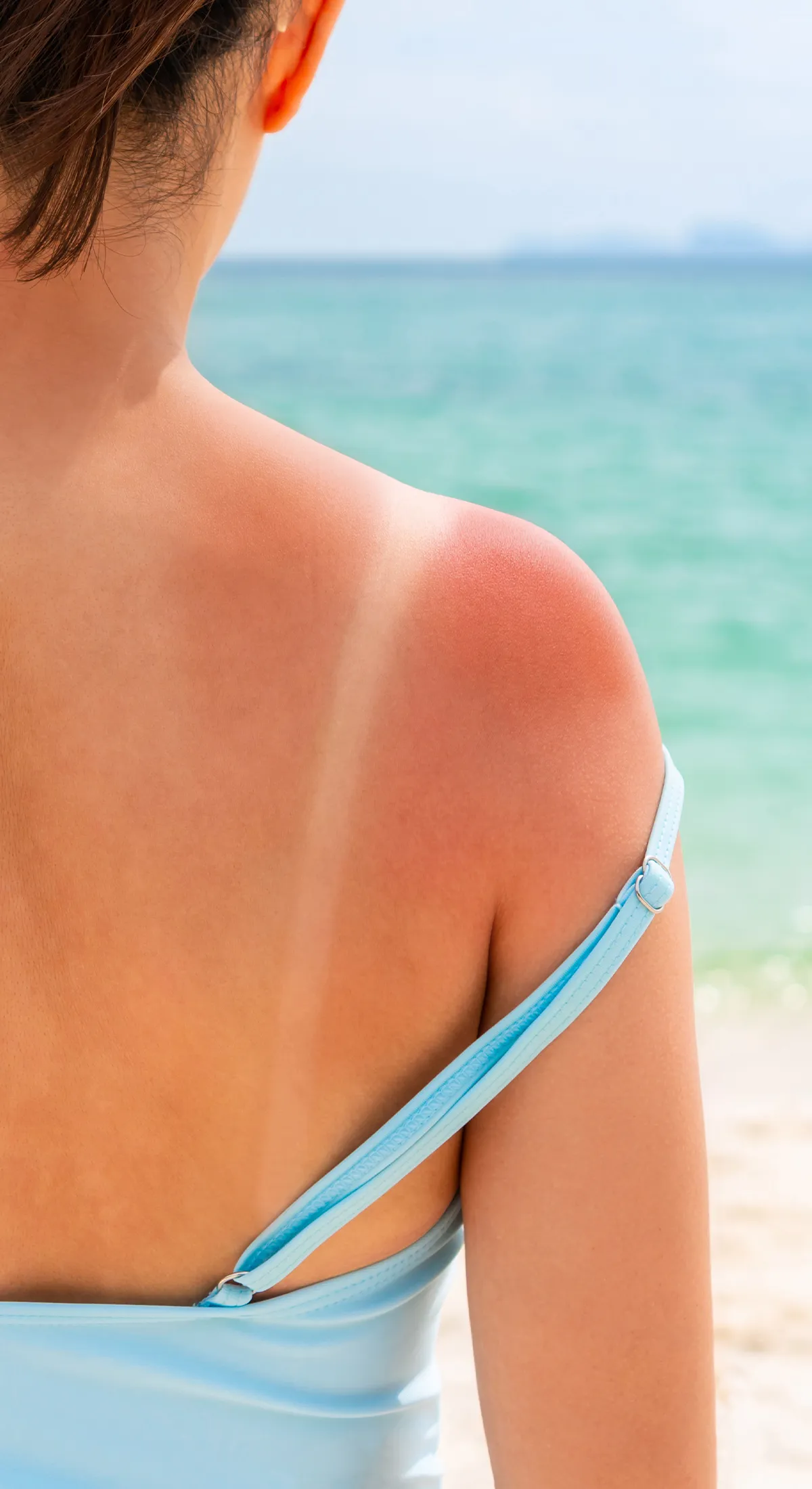 Starker Sonnenbrand im Schulterbereich einer weiblichen Person. Unterschied durch Trägeroberteil sehr gut erkennbar