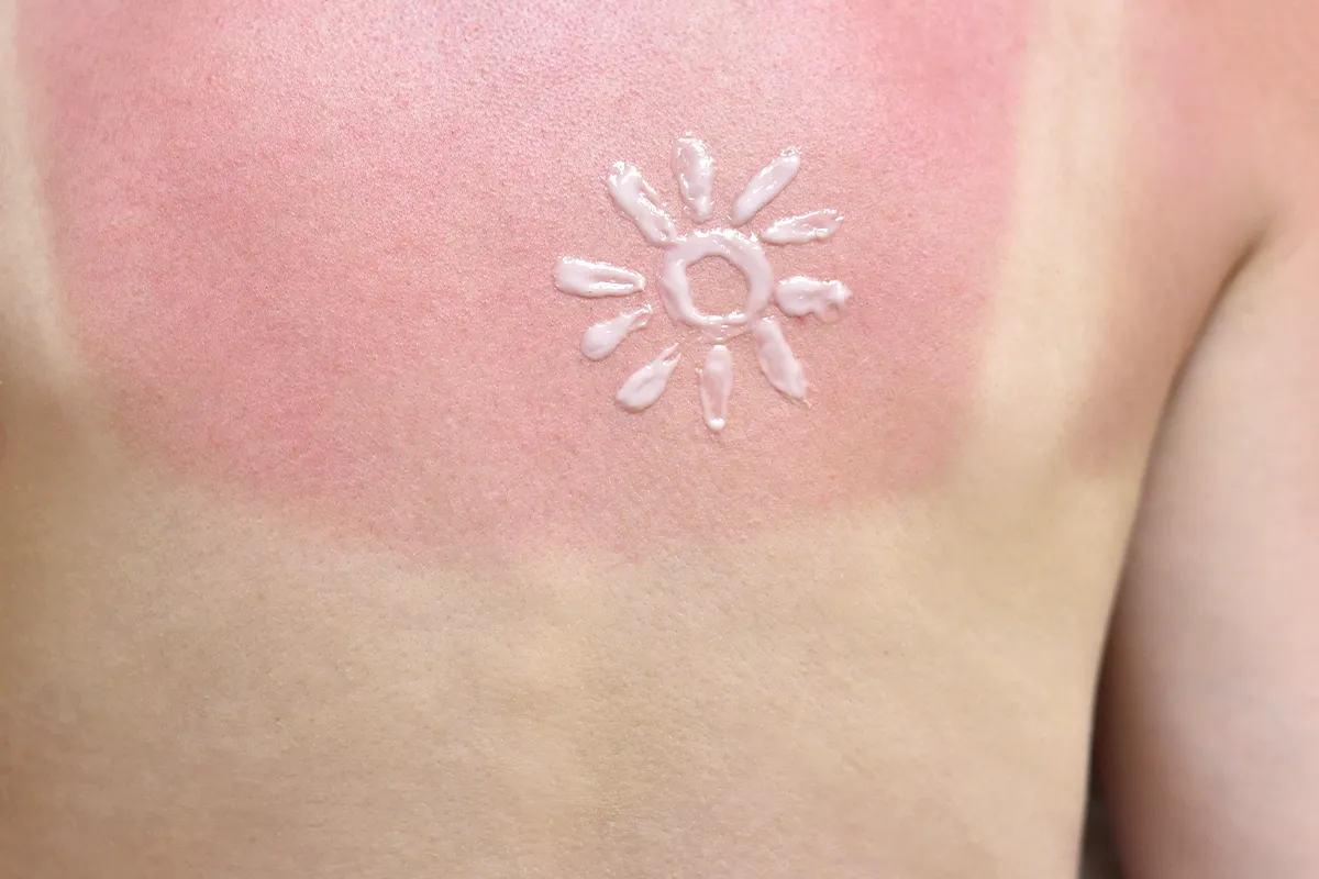 Sonnenbrand im Schulterbereich einer weiblichen Person mit den weißen Striemen eines Trägeroberteils. Eine Sonne ist mit Creme in den Sonnenbrandbereich gemalt