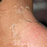 Sonnenbrand im Schulter-, Nackenbreich, wo sich großflächig die Haut abschält