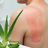 Großflächiger Sonnenbrand im Schulterblattbereich mit abblätternder Haut