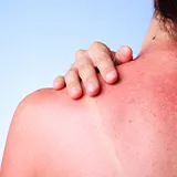 Dunkelroter Sonnenbrand im oberen Schulterbereich. Weißer Striemen durch ein Trägertop zu erkennen