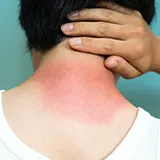 Starker roter Sonnenbrand im Nackenbreich