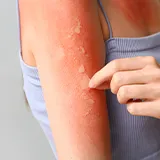 Großflächiger sehr starker Sonnenbrand bei einer weiblichen Person auf Armen und Brustbereich. Auf dem Arm lösen sich Hautpartien