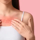 Starker dunkel roter Sonnenbrand mit Schwellungen und Blasen im Dekolletébereich