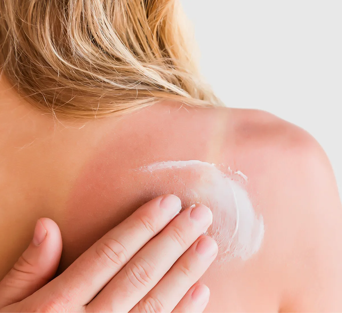 Eine Person trägt Creme auf den sonnenverbrannten Schulterbereich einer Frau auf