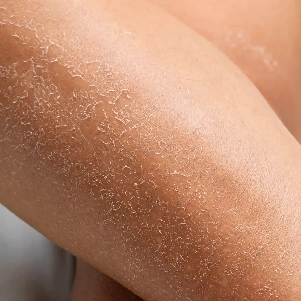 Großflächige trockene Hautpartien